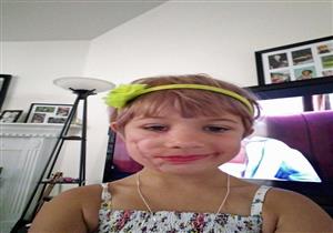 بالصور-بعد "التشوه" طفلة تعالج نفسها بالتقاط صور السلفي