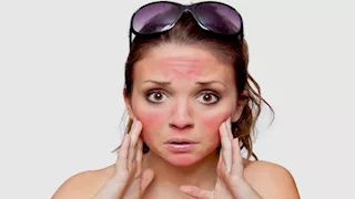 أعراض حساسية الشمس وأهم أسبابها