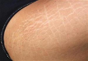 اكتشاف فائدة غير متوقعة للسيلوليت