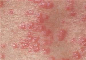 استشاري جلدية: الجرب طفح جلدي لا علاقة له بالنظافة الشخصية