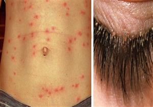  بعد ظهور حشرة أثارت الذعر في المعادي .. إليك أنواع القمل من الرموش للجسم