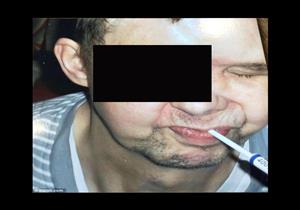 تشخيص خاطئ للصداع النصفي يتسبب في حفرة بوجه مريض 