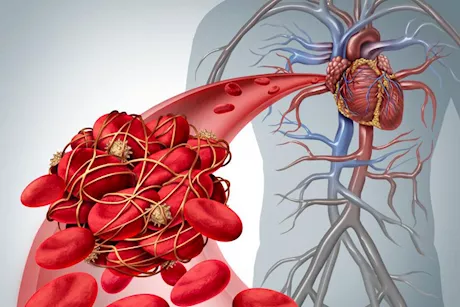 جلطة الدم.. إليك الأسباب وطرق العلاج