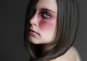 الكدمات بالجسم- دليلك الشامل للتعرف عليها