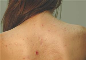 الموافقة على دواء جديد لعلاج سرطان الجلد