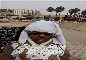 بعد نشر "مصراوي" قصة معاناتها.. محافظ سوهاج يكلف بعلاج "طفلة القمر"