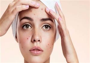 3 أخطاء عند وضعك للمكياج تسبب لكِ ظهور الحبوب 