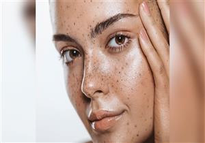 حلول فعالة للتخلص من نمش الوجه 