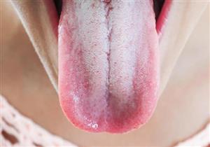 من اللسان.. اعرف حالتك الصحية 