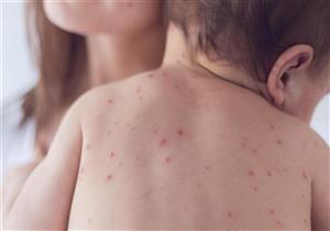 مع اقتراب حملة الصحة.. إليكِ أعراض الحصبة وتطعيماتها