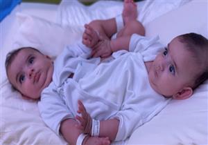 13 ساعة و 35 متخصصا.. تفاصيل عملية فصل توأم سيامي في السعودية