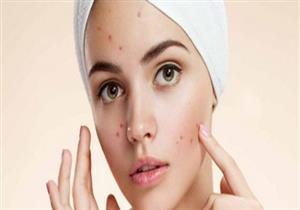 مادة فعالة لعلاج حب الشباب.. تعرف عليها