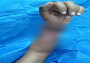 بالصور.. مستشفى أسيوط يعيد يد شاب لمكانها بعد بترها بالكامل في حادث