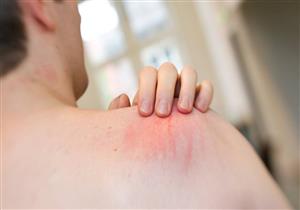 تعاني منها في فصل الشتاء؟.. 8 أطعمة تحد من الإصابة بالالتهابات الجلدية