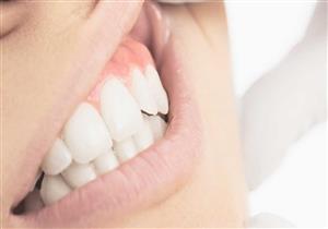 هذا النبات علاج طبيعي لالتهابات اللثة وآلام الأسنان 