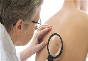 منها تغير لون الجلد.. 9 أعراض شائعة تنذر بالإصابة بالسرطان