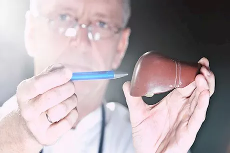 هل دهون الكبد تسبب أورامًا؟