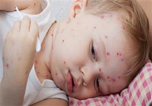 الصدفية تهاجم الأطفال أيضا