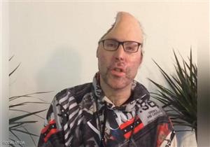 حادث يتسبب في فقدان مطرب راب نصف رأسه