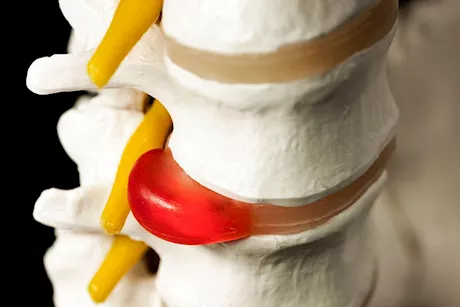 العلاج الطبيعي والانزلاق الغضروفي.. هل يُعد فعالاً لعلاجه؟