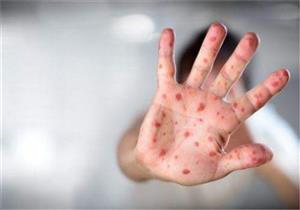 اليابان تشهد أسوأ تفشي للحصبة منذ 10 سنوات