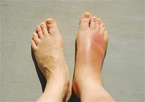 تثاقل الأقدام ينذر بقصور الأوردة.. إليكم العلاج 