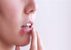 الجدري في الصغر يهددك بالهربس في الكبر