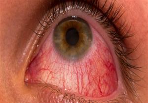 أدوية تهددك بجفاف العين.. إليك طرق الوقاية