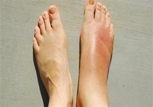   قبل رمضان.. تورم قدميك تشير إلى حالة صحية تتطلب استشارة الطبيب فورا