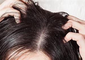 قشرة الرأس قد ترتبط بمرض خطير