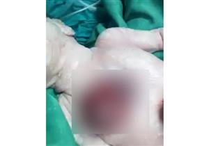سيدة تلد طفلة بقلب خارج جسدها في سوهاج 