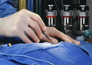 #بث-الأزهر-مصراوي.. ما حكم زراعة الكُلى المتبرع بها أو الصناعية؟