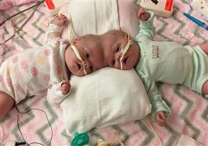 في حالة نادرة.. نجاح عملية فصل أصغر توأم ملتصق