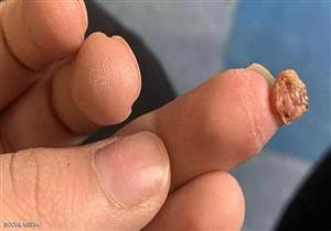  صورة تكشف ما يمكن أن تفعله الأدوات الملوثة بالأظافر