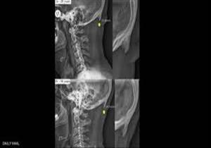 بسبب الهواتف الذكية..دراسة تحذر من ''شوكة الجمجمة''