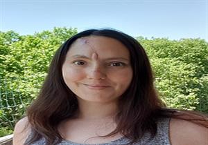 الشمس تشوه أنف فتاة مهووسة بالتان وتصيبها بالسرطان.. كيف ذلك؟ (صور)