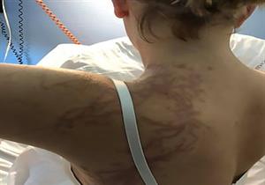 قنديل البحر يشوه جسد فتاة.. ما العلاج لهذه الحالات؟ (صور)