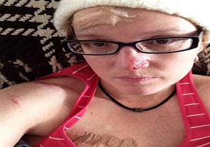 بسبب الشمس.. امرأة تجري 86 جراحة لإصابتها بهذا المرض (صور)