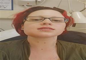 بسبب ضرس العقل.. تعفن الدم يضع فتاة بين الحياة والموت