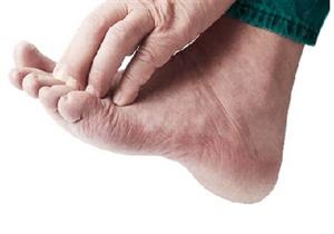 دراسة: الجلد السميك المصاب بالكالو في القدم له قدرات خارقة 