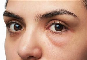 أسباب عديدة وراء الإصابة بـ"أكياس العين".. كيف نتخلص منها؟