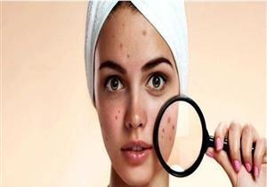 3 أشكال لـ"حَب الشباب".. إليك الأسباب والعلاج 