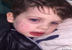قبلة تصيب طفل بمرض جلدي خطير.. ما السبب؟