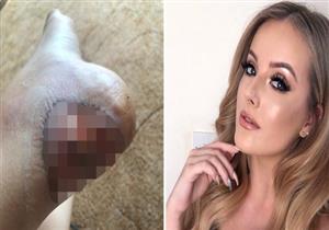 حذاء جديد يصيب فتاة بتعفن الدم.. ماذا حدث؟