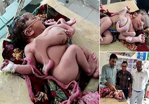 أربعة أرجل وثلاث أذرع.. سيدة هندية تنجب طفلة تشبه الأخطبوط 