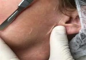 كل ما تريدين معرفته عن تقنية "الديرما بلانينج"