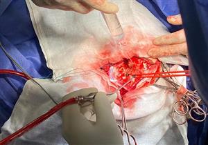 جامعة حلوان: نجاح فريق طبي بإجراء جراحة لاستئصال ورم في المخ لمريضة 