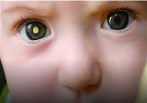 5 أعراض تكشف إصابة طفلِك بـ"كوتس"..  مضاعفاته قد تصل للعمى
