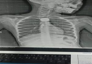 استخراج "2 جنيه" من مريء طفلة في قنا