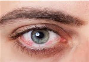 8 أسباب لاحمرار العيون لم نكن نعرفها.. بينها "العدسات اللاصقة وكورونا" 